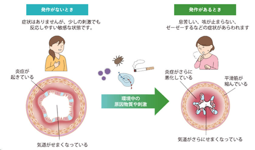 気管支喘息のイラスト